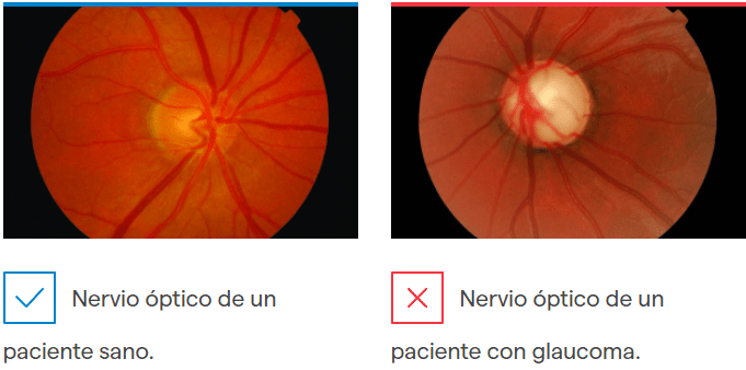 Operación de glaucoma: Tratamiento quirúrgico | IMO